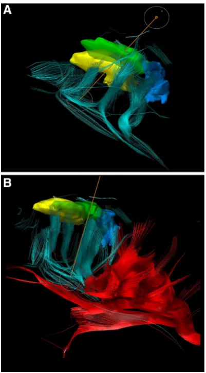 Fig. 1 3D reconstruction of ﬁber tracking showing the parcellatedparcellated cortical areas.(as a part of SLF) showing the direct connectivity to the cortexsegmentated incortical areas with corresponding connection ﬁbers