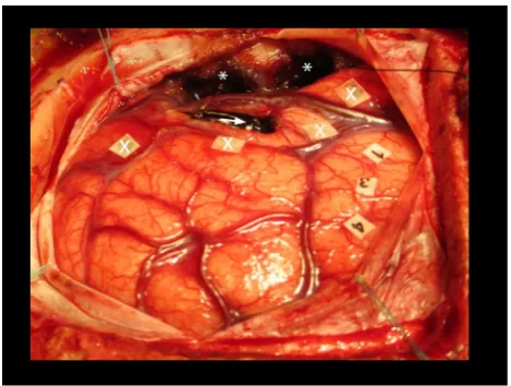 Fig. 2 Whole brain surface rendering showing the parcellatedpathological areas divided by their connectivity to the ﬁber tracts.Green represents the area of direct connection of the lesion to the SLFvia arcuate fascicle