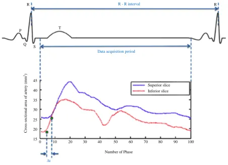 Figure 2.  Intersecting tangents method. The transit time is determined by “foot” points of two distension waveforms