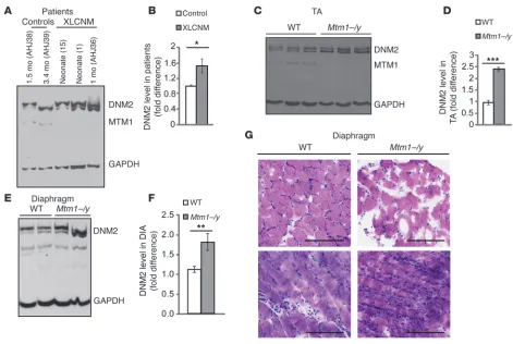 Figure 1DNM2 levels in XLCNM. (A) Representative Western blot of XLCNM patient muscle lysates for DNM2, MTM1, and GAPDH loading control