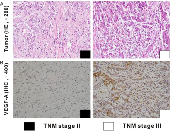 Figure 3. Correlation between the VEGF-A expression and the TNM stage in human gastric adenocarcinoma