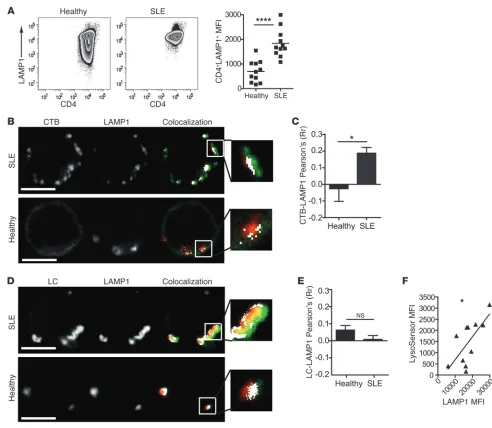 Figure 5Increased LAMP1 expression and altered lipid colocalization to functionally normal lysosomes in SLE CD4bars: 5 healthy donors were fixed and permeabilized before staining for LAMP1 and either CTB (donors and 11 SLE patients were surface stained for