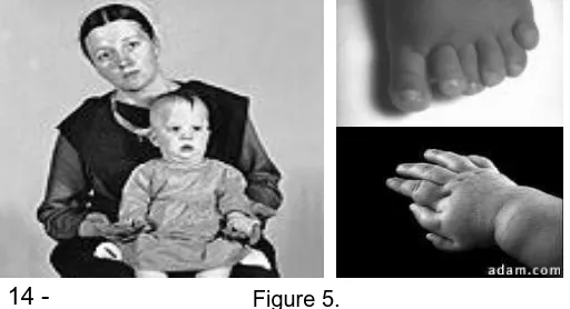 Figure 5. Amish child with Ellis van Creveld syndrome
