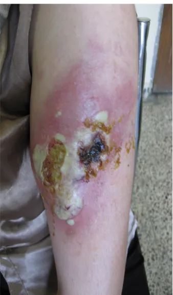 Figure 2. Showing panniculitis is and pyoderma in the left wrist in female patient.                                            