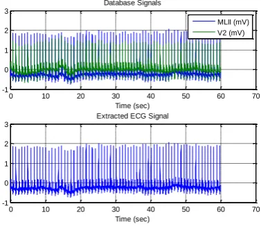 Fig (f): Extraction of ECG signal using QRS information 