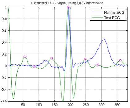 Fig (l): Extraction of ECG signal using QRS information 
