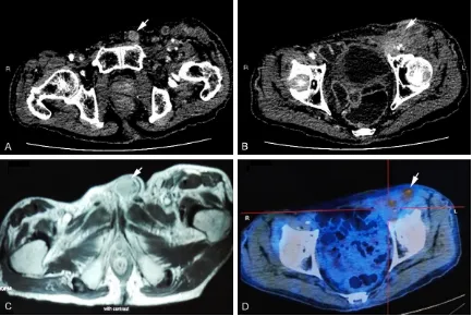 Figure 1. Radiographic findings of the patient after admission. Contrast-enhanced CT scan indicates: (A) The tumor in the left spermatic cord completely surrounds the left external iliac vein (white arrow); (B) Such spermatic cord tumor has heterogeneous d