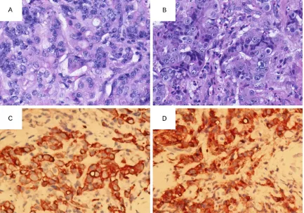 Figure 2. The histopathologic examinations of spermatic cord metastasis from gastric adenocarcinoma