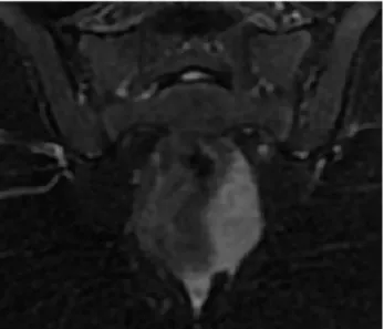 Figure 3: FDG-PET scan showing homogenously  enhancing mass in pre-sacral region on left side 