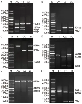 Figure 1. Electropherogram of PCR products at each gene locus. Notes: A: zygote; TT: Mutant homozygote; D: Electropherogram of CYP19 +19C>T lo-cus after BSP1286 I enzyme digestion, CC: Mutant homozygote; TC: Mutant heterozygote; TT: Mutant homozygote; E: Electropherogram of VDR Apa I locus post Apa I enzyme digestion; M: Marker; AA: Wild-type homozygote; Aa: Mutant heterozygote; aa: Mutant homozygote; F: Electropherogram of VDR Fok I locus post Fok I enzyme digestion, FF: Wild-type homozygote; Ff: Mutant heterozygote; ff: Mutant heterozygote; M: Marker; PCR = polymerase Electropherogram of SRD5A2 A49T locus after Rsai enzyme digestion, M: Marker; AA: Wild-type homozygote; AT: Mutant heterozygote; TT: Mutant ho-mozygote; B: Electropherogram of SRD5A2 V89L locus after HYF10VI en-zyme digestion; M: Marker; VV: Wild-type homozygote; VL: Mutant heterozy-gote; LL: Mutant homozygote; C: Electropherogram of CYP17 -34T>C locus after MspA1I enzyme digestion, CC: Mutant homozygote; TC: Mutant hetero-chain reaction.
