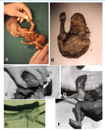 Figure 6. (A)-(F) showing limb body wall complex/amniotic band syndrome cases featuring disruption of upper half of body including abdomen, thorax and head (A), constriction bands (A, F; arrow), membrane/amniotic band attachment (E; arrow), limb amputation