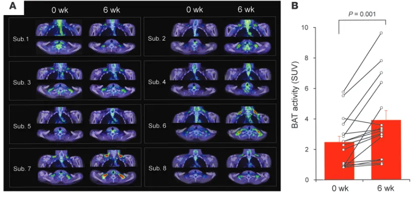 Figure 2BAT recruitment by chronic cold exposure. FDG-PET/CT images (A) and BAT activity (B) of 8 subjects before and after the 6-week daily cold exposure