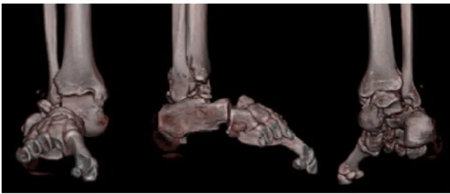 Figure 1. Subtalar dislocations are divided into medial, lateral, and anterior/posterior dislocations depending on the position of the calcaneus in relation to the talus