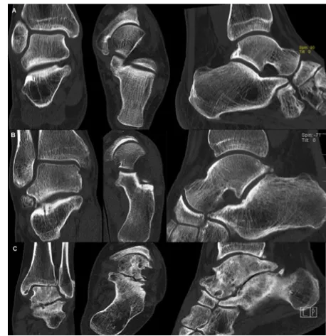 Figure 2. Computer tomography scans of the hindfoot with different extent of arthritis