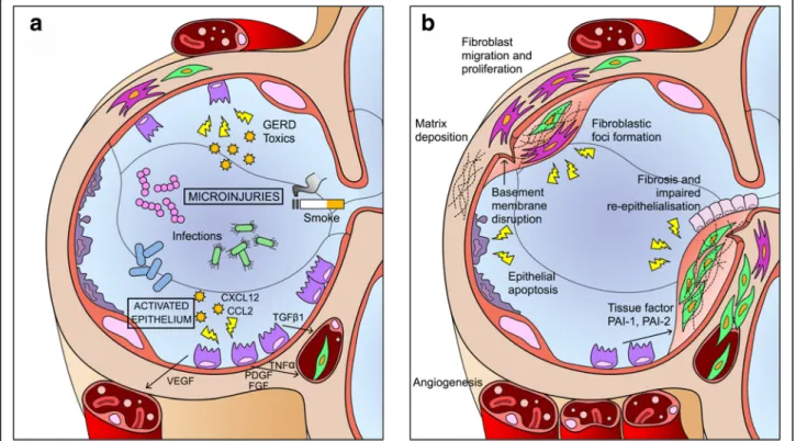 Fig. 1 Schematic view of IPF pathogenesis. Repeated injuries over time lead to maladaptive repair process, characterized by AEC2s apoptosis, proliferation and epithelium-mesenchymal cross-talk (a) and following fibroblasts, myofibroblasts proliferation and