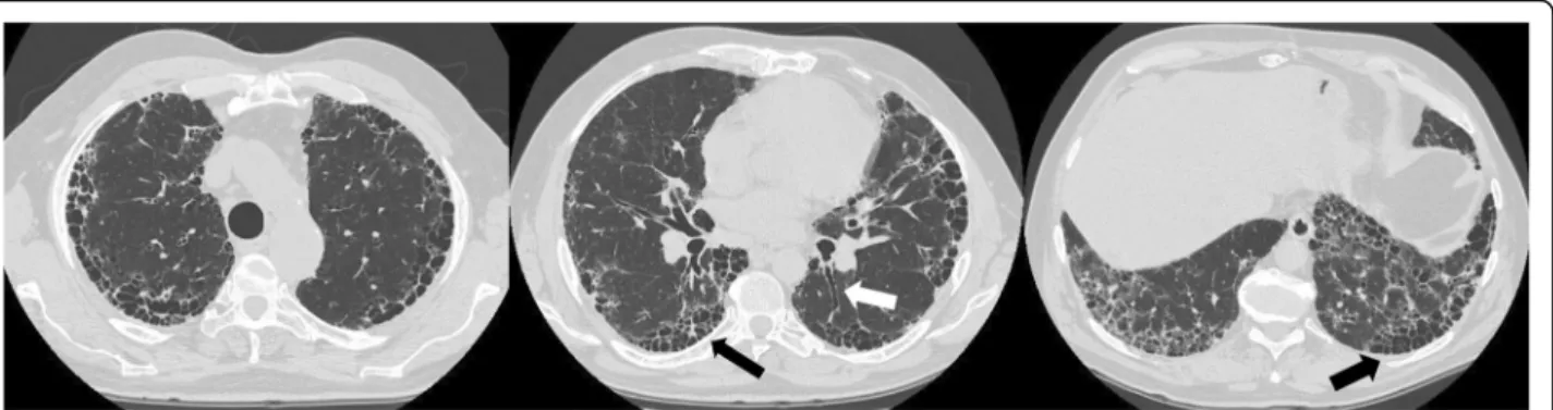 Fig. 2 Typical Usual Interstitial Pneumonia pattern on high resolution computed scan sections showing upper, middle and lower lung regions from left to right