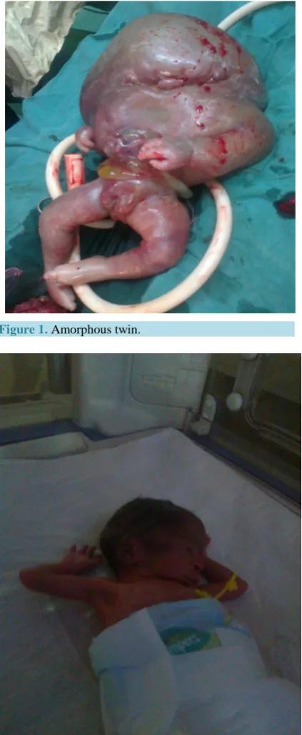 Figure 1. Amorphous twin.                         