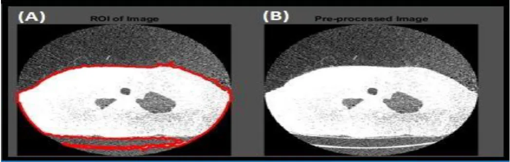 Fig.2 ROI analyses of the lung cancer images for classification (a) ROI region for feature extraction (b) Pre-processed image of lung cancer 