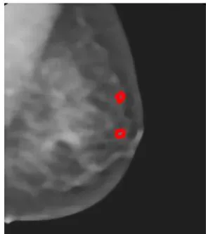 Fig-4: Cancer spot segmented  
