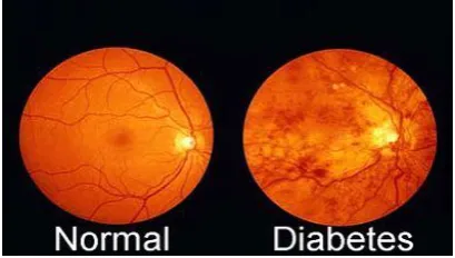 Figure  difference of normal and diabetic macula [13] 
