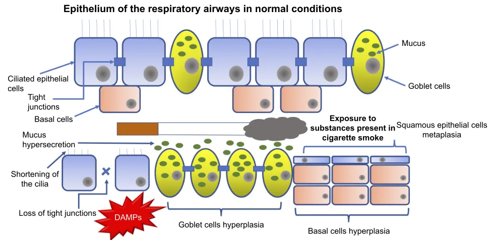Figure 1 When airway epithelium is exposed to harmful substances, such as those contained in cigarette smoke, it changes its structure.Note: These changes include the loss of close junctions between ciliated epithelial cells, shortening of cilia, hyperplasia of goblet-producing goblet cells and basal cells, in addition to squamous epithelial cell metaplasia.Abbreviation: DAMPs, damage-associated molecular patterns.