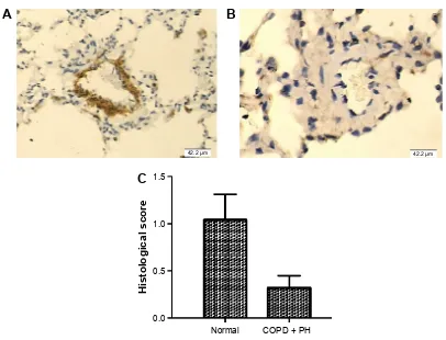 Figure 3 expression of sMaD4 and PTen in the Ph patients with or without COPD.Notes: The expression pattern of sMaD4 was determined in PasMCs collected from COPD patients with Ph and normal controls by using real-time PCr (A) and Western blot (B, densitome