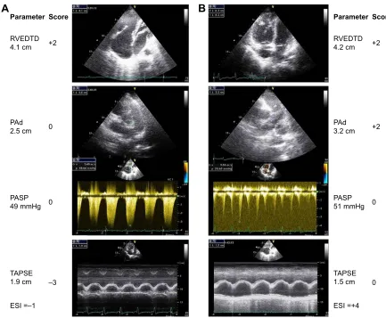 Figure 3 representative echocardiographic images of rVeDTD, PasP, Pad, and tricuspid annular plane systolic excursion as well as the score calculation for two patients