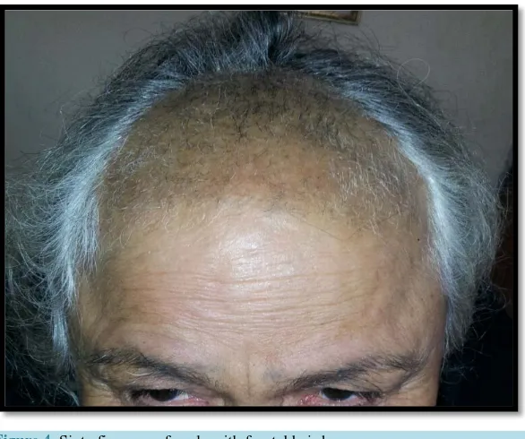 Figure 3. Thirteen years male with multiple patches of hair loss so-called alopecia areata like
