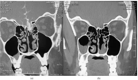Figure 4. Radiologic criteria of elevated ICP (a) T2 weighted MRI showing slit-like ventricles and tight subarachnoid spaces (b) Sagittal CT scan showing tortuous optic nerve