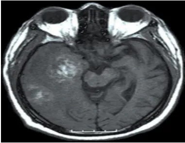 Fig:3: MRI Scan of Brain  