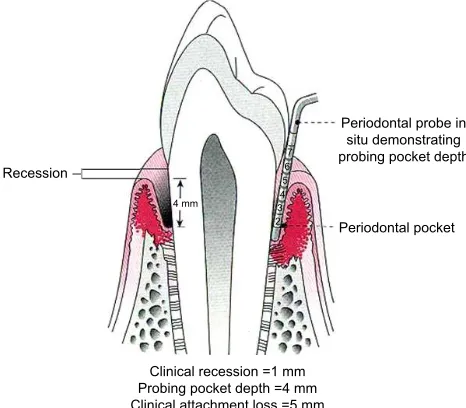 Figure 1 Probing pocket depth (PPD – distance in millimeter from gingival margin to base of pocket) and clinical attachment loss (CAL – distance in millimeter from cement–enamel junction to base of pocket).Note: Copyright © 2002