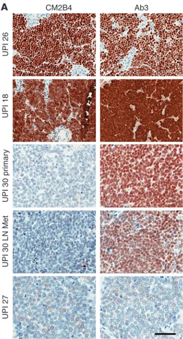 Figure 3Comparison of Ab3 and CM2B4 immunohistochemistry staining of MCC. (A) UPI 26 and UPI 18: 3+ staining with CM2B4 and Ab3; UPI 30: primary and metastatic (Met) lymph node–negative staining with CM2B4 and 2+ with Ab3; UPI 27: 1+ staining with CM2B4 an