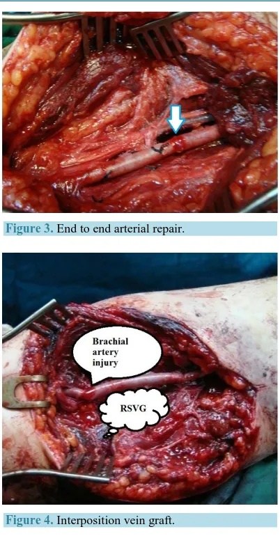 Figure 3. End to end arterial repair. 
