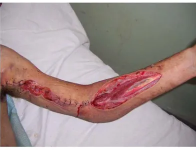 Figure 5. Fasciotomy of the forearm and partial wound closure following brachial artery repair