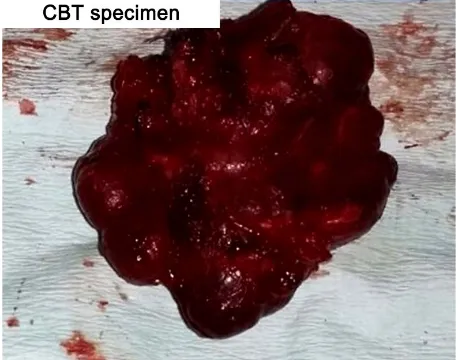 Figure 4. Operative photo of a carotid body tumour. 