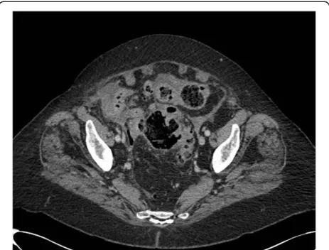 Figure 2 Slightly thickened sigmoid diverticular disease, withoutabscess or perforation.
