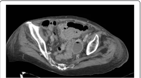 Figure 4 Sigmoid diverticulitis with associatedabscess formation.
