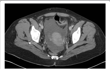 Figure 5 Distant retroperitoneal free gas by perforateddiverticular disease.