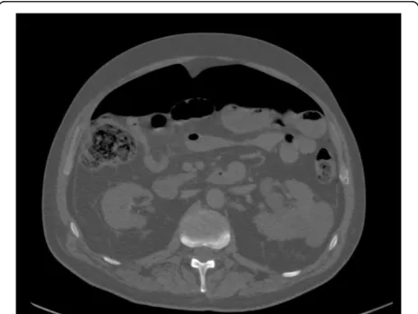 Figure 7 Distant free air in patient with diverticulitis perforation.