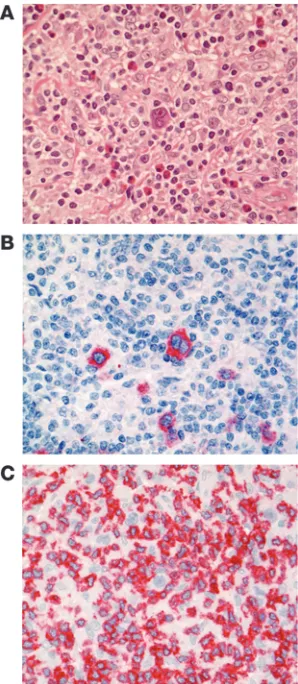 Figure 1Morphology and immunohistochemical features of HRS cells. Typical 