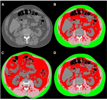 Figure 1 Body composition analysis and differences in fat distribution.Notes: examples of a CT slice at l2–l3 before (A) and after segmentation (B)