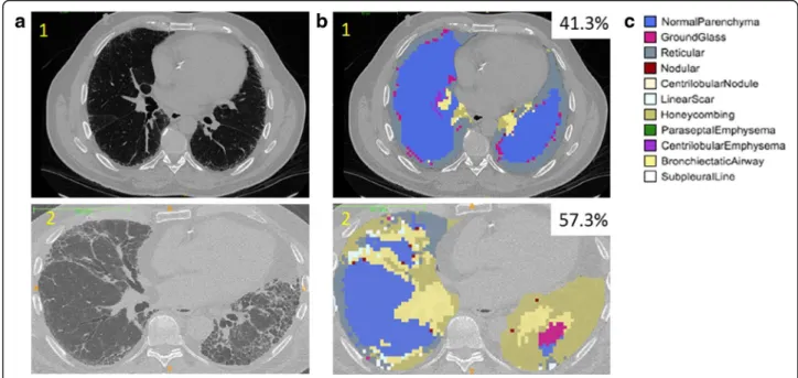 Fig. 3 a Representative CT images from subjects with less severe IPF (patient 1) and more severe IPF (patient 2)