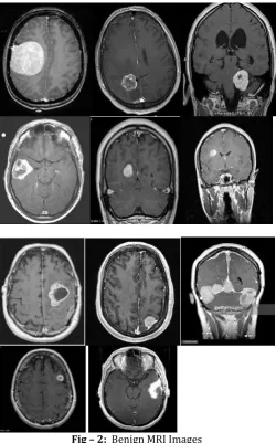 Fig – 3:   Malignant MRI Images [32] 