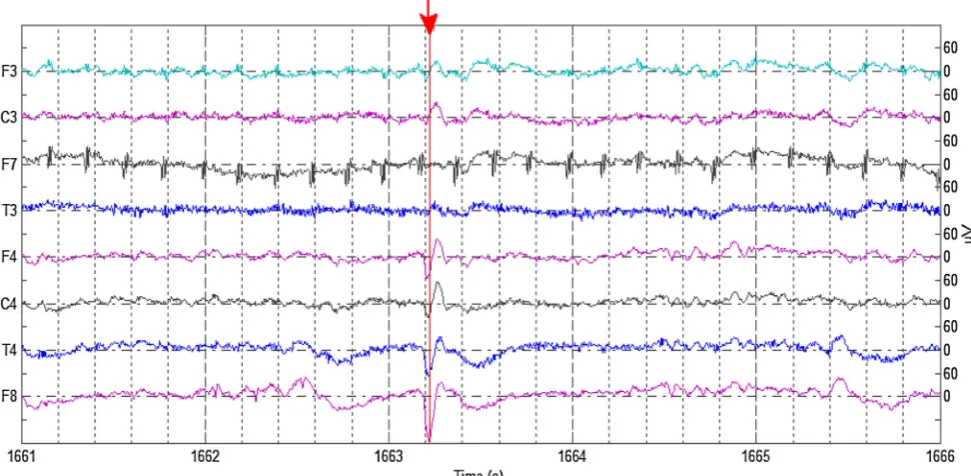 Fig. 1 Spike detection framework. The 1st step of the method detectsspike-like waveforms by extracting the two half-waves