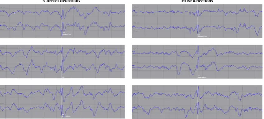 Fig. 4 Illustration example of 3 correct (left) and 3 false (right) spikedetections for the selected channels (1st channel: T4, 2nd channel:F8)