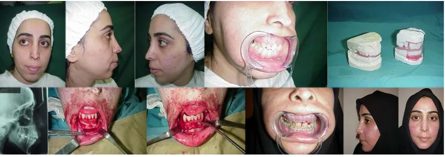 Figure 1. A 28-year-old lady with long face, retruded chin and open bite. The two lower left pictures show horizontal chin bar