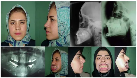Figure 3. Long face and long chin. Before surgery: Upper left two photos. After surgery: Lower right three photos