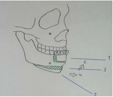 Figure 4. Schematic representation of surgical technique. 1) Man- dibular segmental osteotomy; 2) Jumping genioplasty; 3) Hori-zontal chin bar; 4) Advanced genioplasty; 5) Retruded chin
