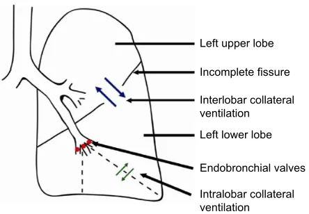 Figure 2 Collateral ventilation.Notes: Schematic figure illustrating the role of intra- and interlobar collateral ventilation, and the implications for bronchoscopic lung volume reduction using one-way endobronchial valves