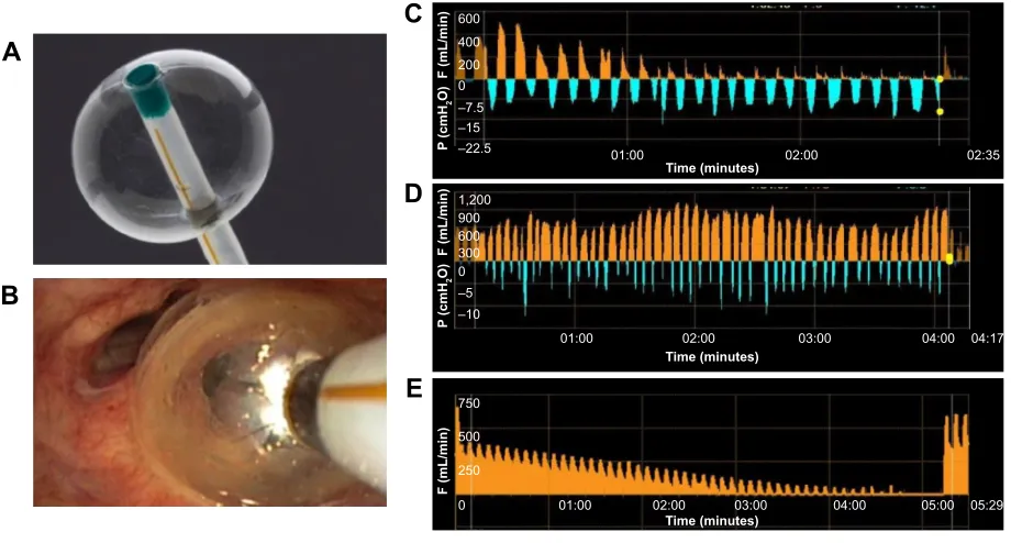 Figure 4 Implanted one-way endobronchial valve.Notes: (A) Open valve, allowing trapped air and fluids to escape
